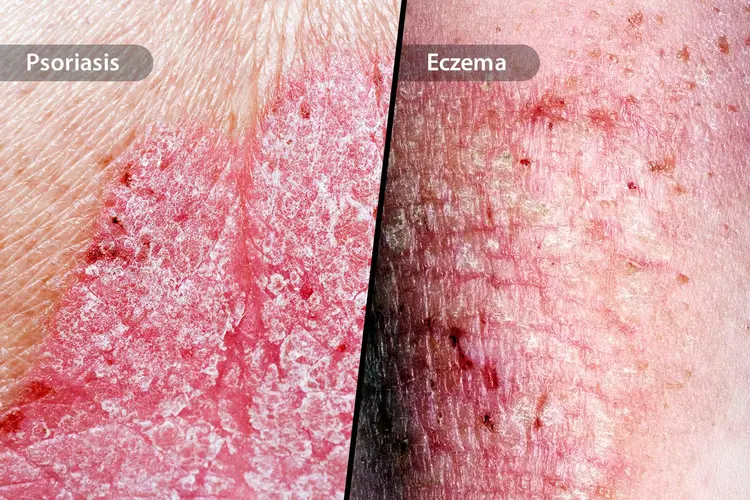 psoriasis-vs-eczema