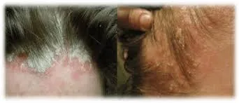psoriasis-vs-seborrheac