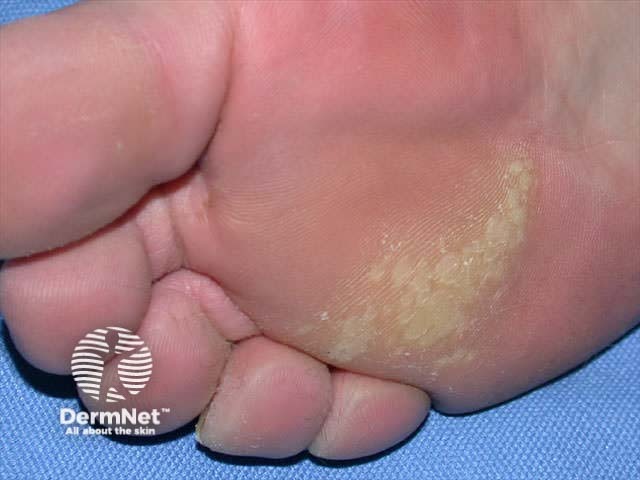 زگیل-موزاییکی