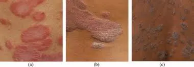 عکس پسوریازیس