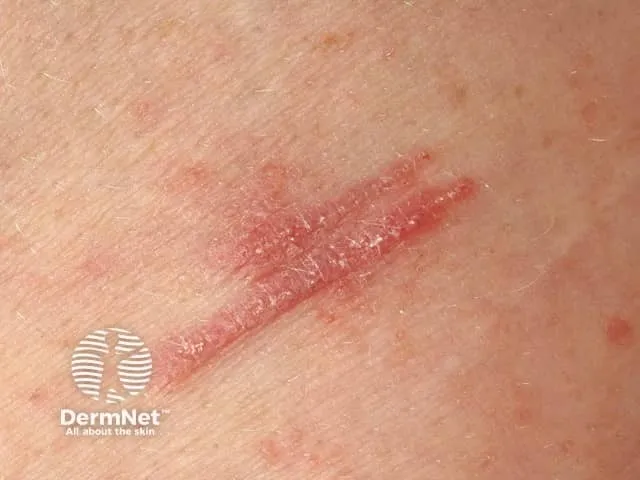 عکس پسوریازیس کوبنر