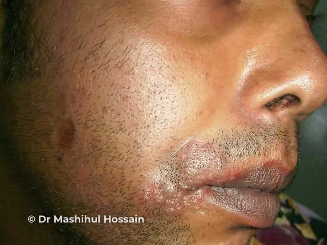 هرپس سیمپلکس