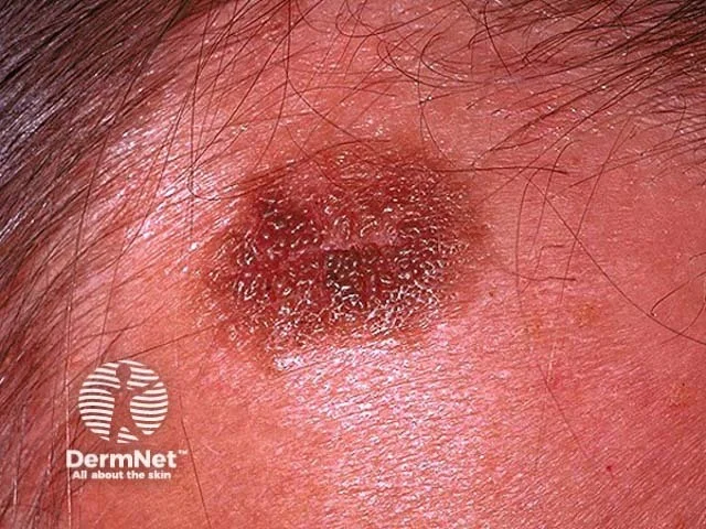 نمونه ضایعه پوستی کراتوز سبورئیک برای تحلیل هوش مصنوعی